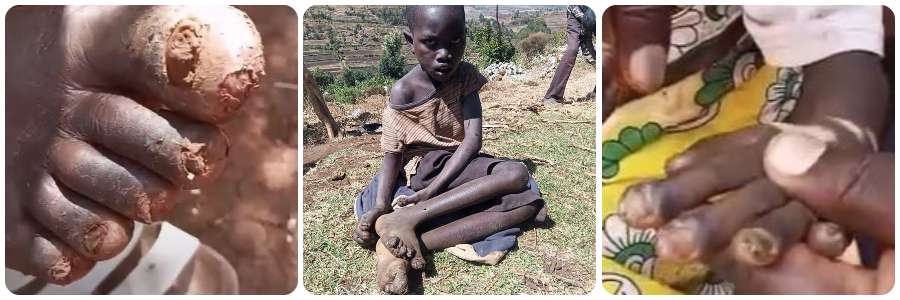 Jiggers Banner Kenya eradicate Treat Help